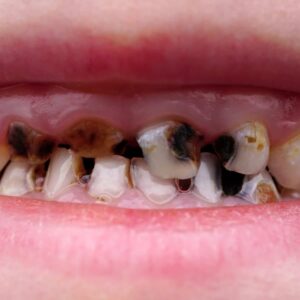 Czy próchnica w zębach mlecznych to normalne zjawisko