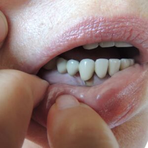 Jak zły stan jamy ustnej obniża nasza odporność.