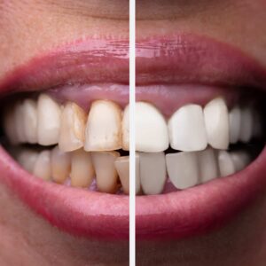 Jak kawa wpływa na zdrowie zębów